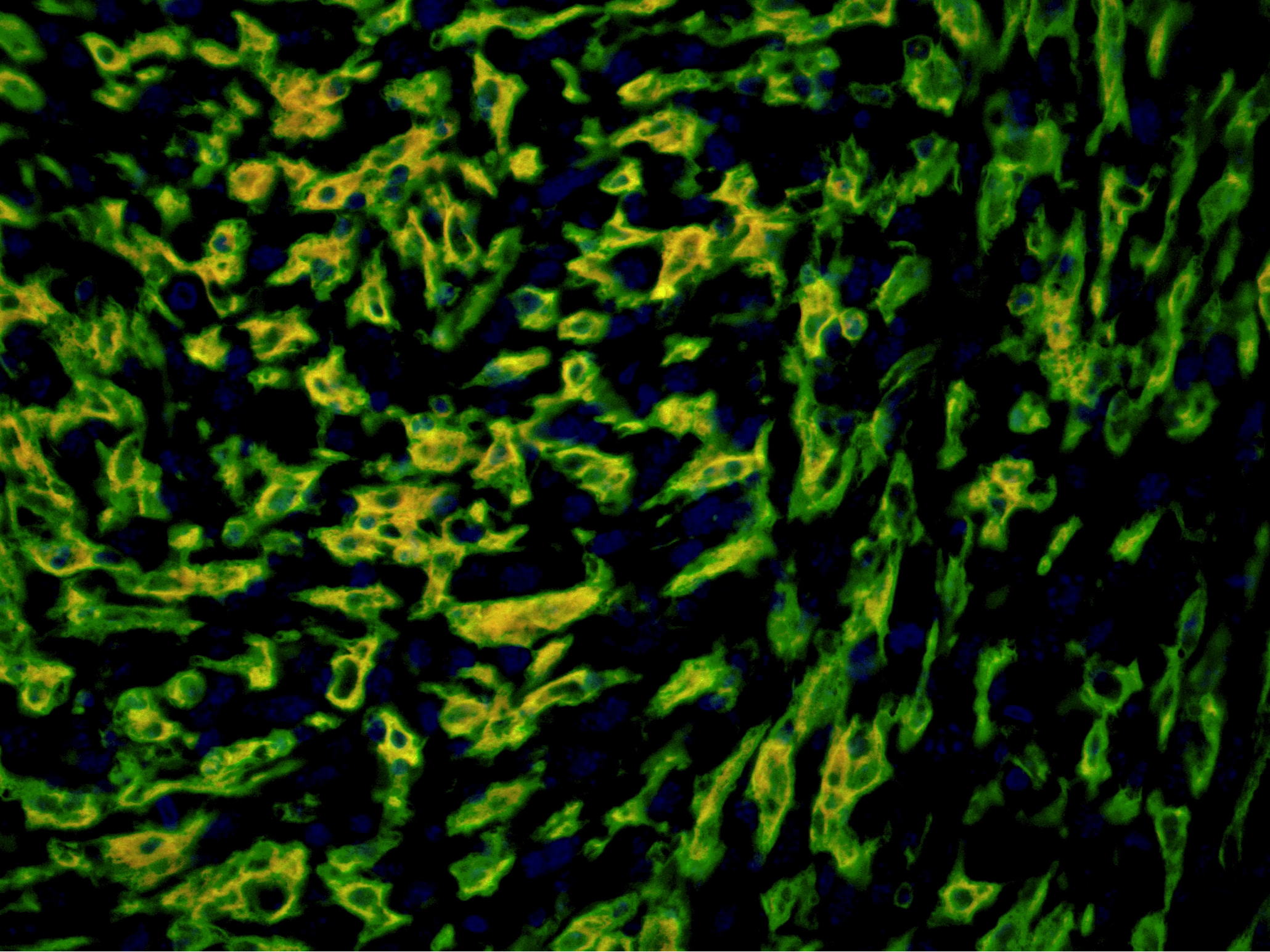 Improving melanoma treatment by blocking an enzyme