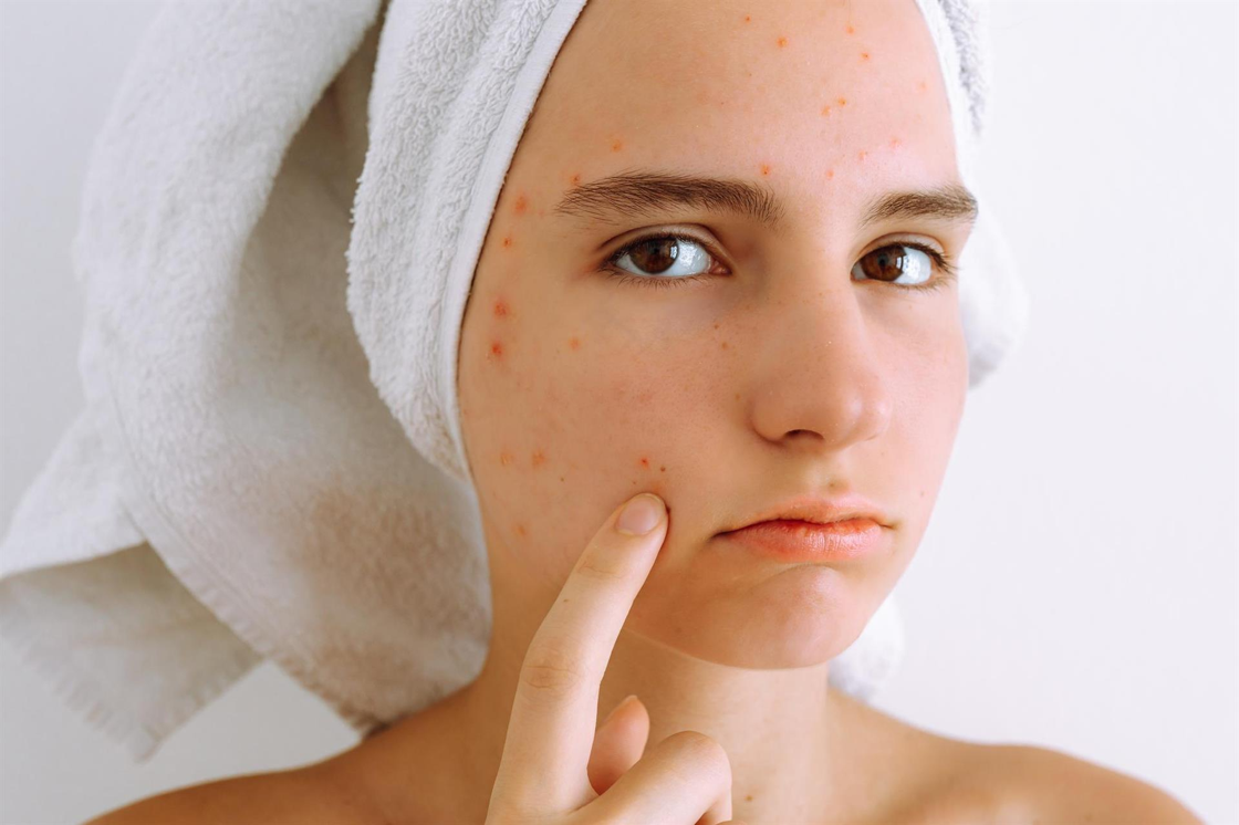 How to Combat Summer Acne: Skincare Strategies and Formulation Guide