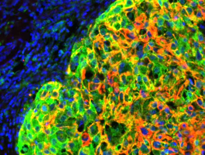The signal that tells breast cancer cells to travel