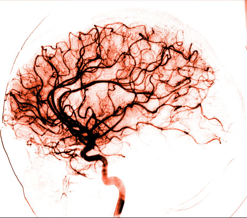 This lateral view from a conventional 2D catheter cerebral angiogram was obtained following selective injection into the internal carotid artery. There is normal opacification of the anterior circulation. No significant abnormalities are seen. Note is made of filling of the inferolateral trunk (artery of the inferior cavernous sinus) with subsequent filling of distal internal maxillary artery branches. AKG8124387 ©akg-images / Medical Body Scans / SCIENCE SOURCE This lateral view from a conventional 2D catheter cerebral angiogram was obtained following selective injection into the internal carotid artery. There is normal opacification of the anterior circulation. No significant abnormalities are seen. Note is made of filling of the inferolateral trunk (artery of the inferior cavernous sinus) with subsequent filling of distal internal maxillary artery branches. AKG8124387 ©akg-images / Medical Body Scans / SCIENCE SOURCE