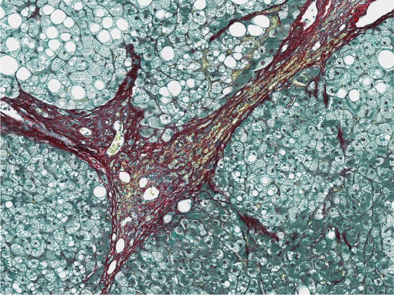 Microscopisch beeld van fibrose in een lever. De rood gekleurde vezels zijn fibrotisch littekenweefsel © Vincent De Smet