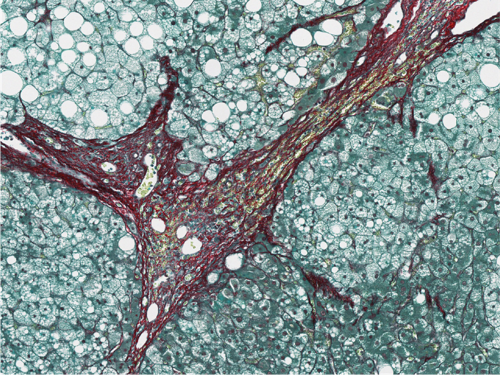 VUB onderzoeksteam ontdekt essentieel eiwit dat bijdraagt aan leverfibrose