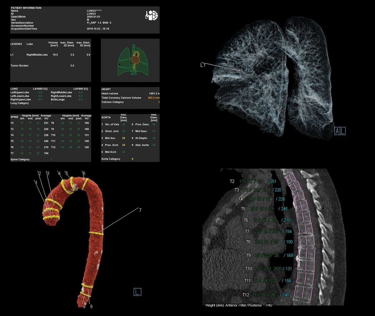 Un exemple des résultats que le radiologue reçoit de AI-Rad Companion qui inclus un pictogramme coloré, des reconstructions 3D des poumons, du cœur, de l’aorte et de la colonne vertébrale ainsi que les images originales avec la mise en évidence des anomalies détectées. 