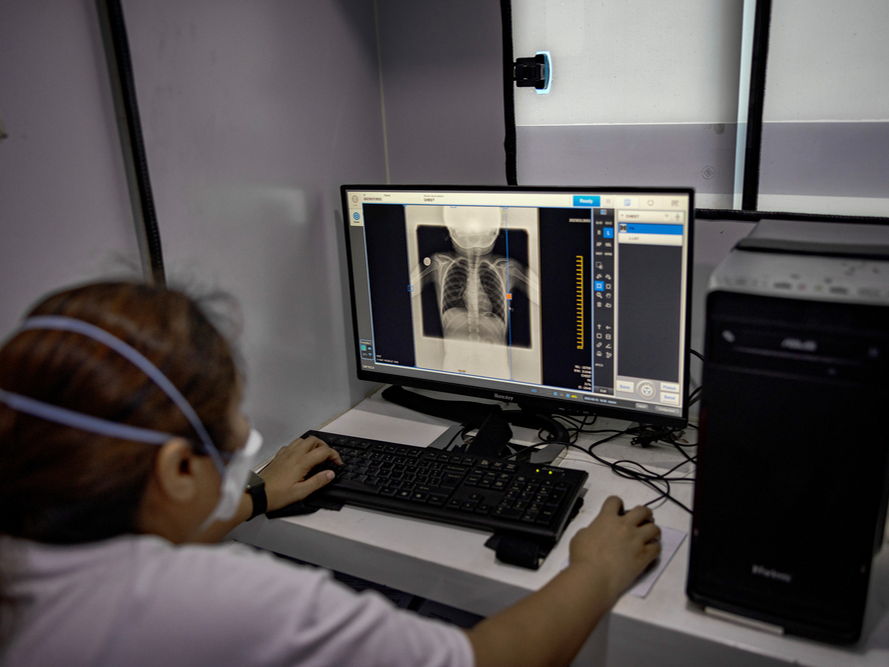 Inteligencia Artificial contra la tuberculosis