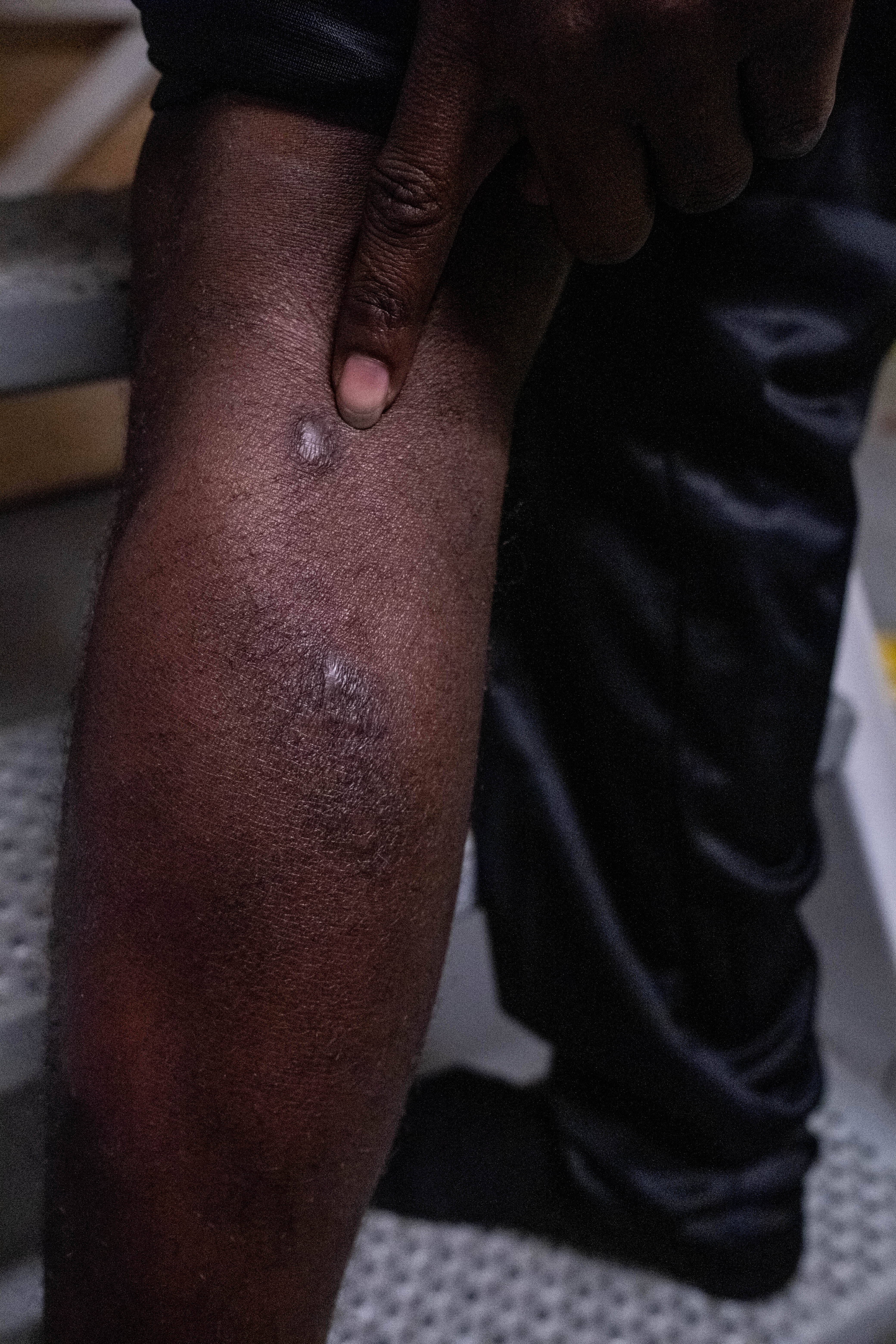 Haidar muestra las cicatrices de las heridas infringidas en un centro de detención en Libia donde sufrió tortura y violencia, incluida la paliza con un objeto metálico. © Nyancho NwaNri ​