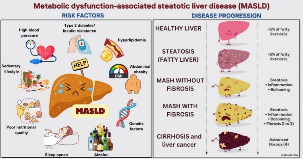 MASLD-associated risk factors and disease progression