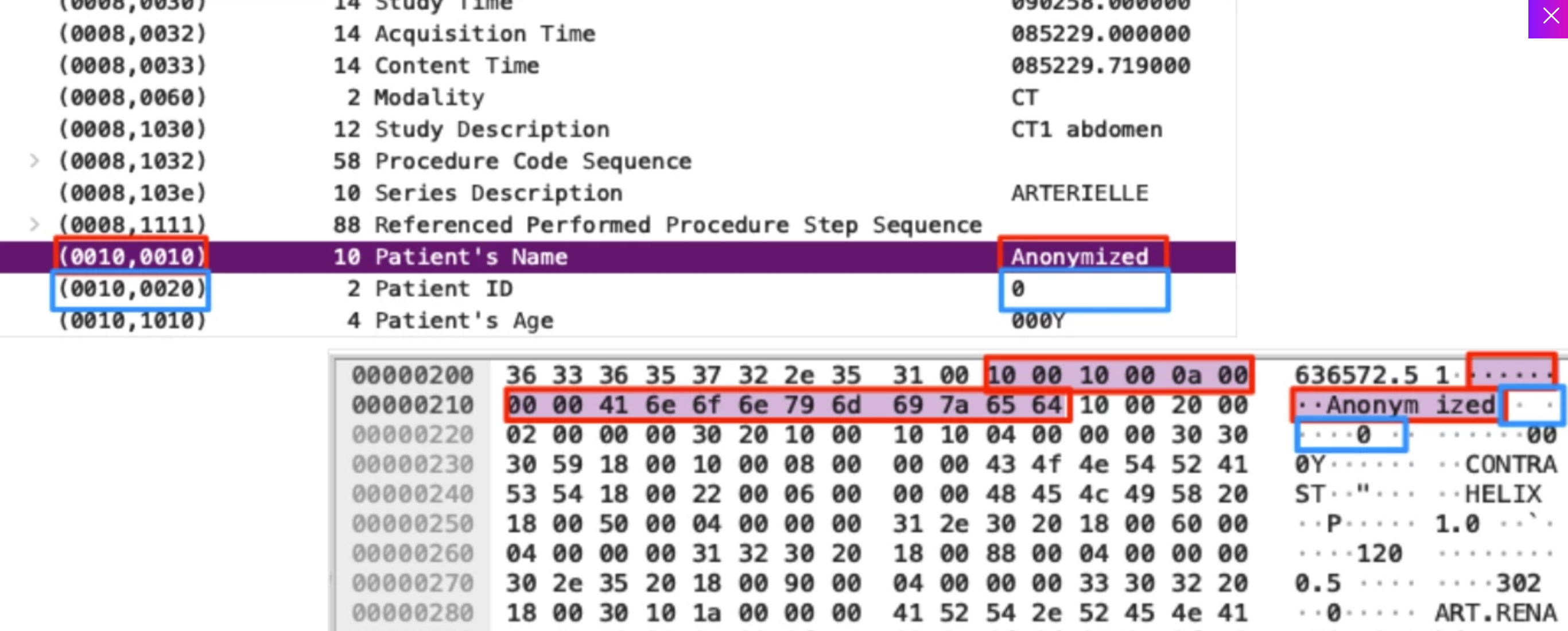 Wiresharkによって解析されたさまざまなタグを含む DICOMパケット。 患者名（赤）、患者 ID（青） のタグが表示され、 この特定のDICOMセッションでは暗黙的な転送構文が使用されます。