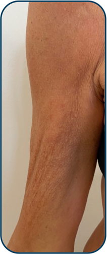 after arm