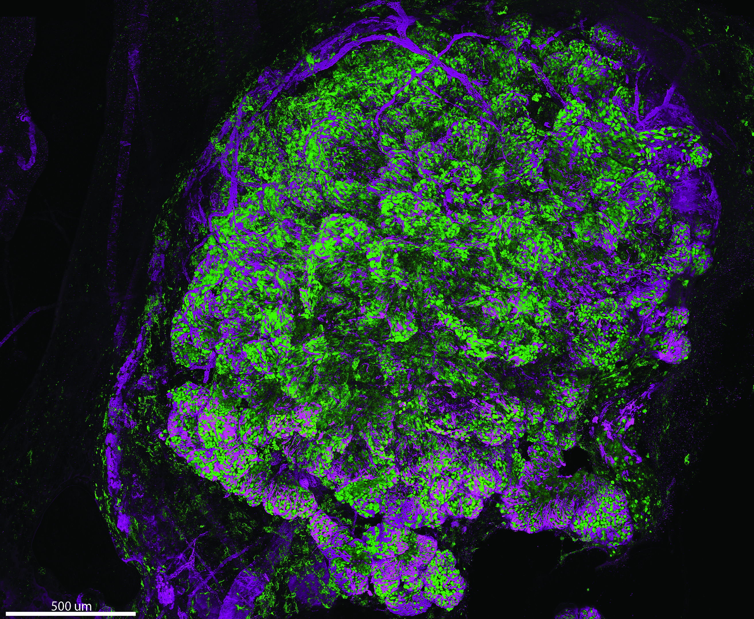 Expansive growth of DCIS cells (green) in murine breast epithelium (purple)