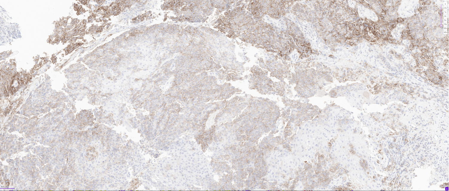 Scan of a tumour without AI analysis. Scan of a tumour without AI analysis.