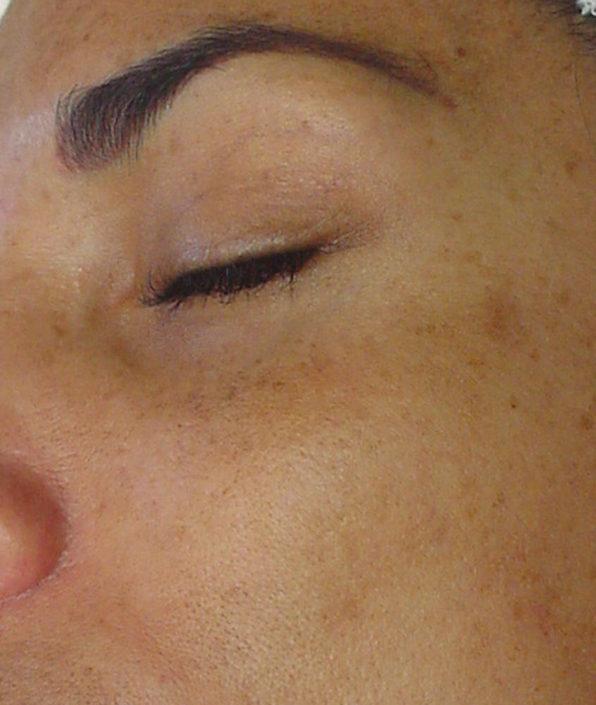 Hyperpigmentation_Before