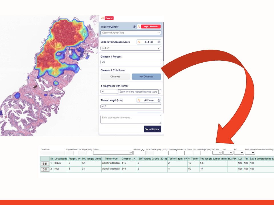 Primeur: slimme software schrijft rapport na onderzoek prostaattumor  