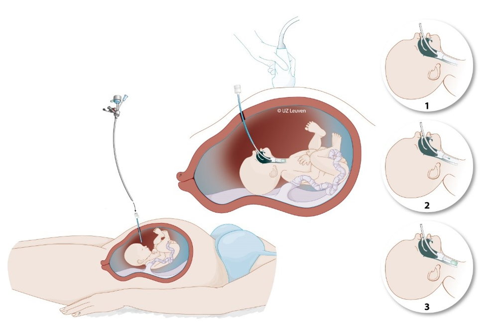 Illustratie van de foetale procedure bij een aangeboren middenrifdefect (© UZ Leuven)