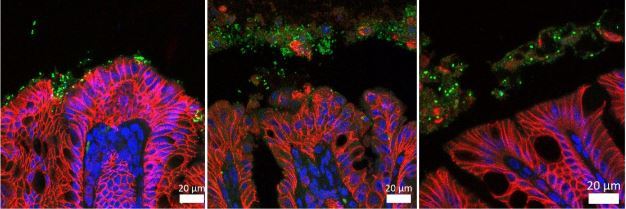 E. coli bacteria (green) and adhesin (red) in colon tumors in mice.