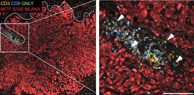 Researchers uncover surprising role of 'natural killer' cells in resistance to cancer immunotherapy