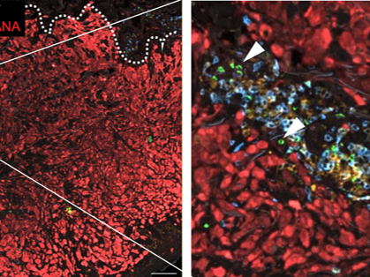 Researchers uncover surprising role of 'natural killer' cells in resistance to cancer immunotherapy