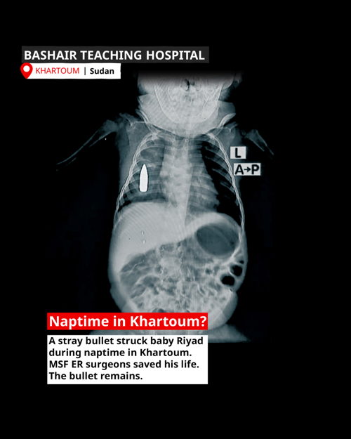 XRay of Baby Riyad. The 18-month-old toddler was struck in the chest by a stray bullet while he was taking a nap in Khartoum. Copyright: MSF