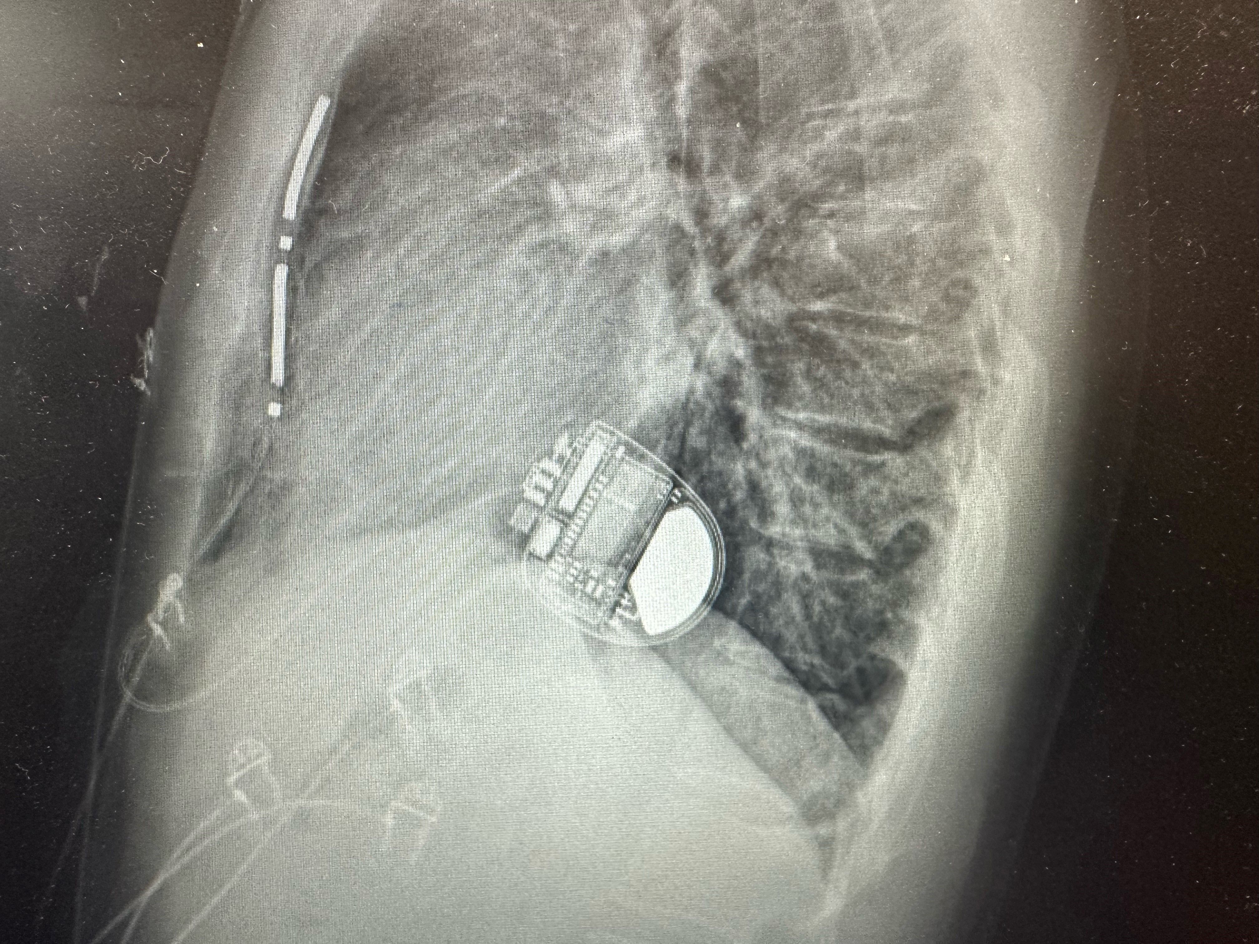 Vanuit deze positie kan de defibrillator zowel het hart stimuleren als een elektrische schok toedienen.