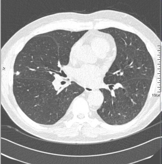 CT-scan toont longnodule links in beeld, in de rechterlong © UZ Leuven