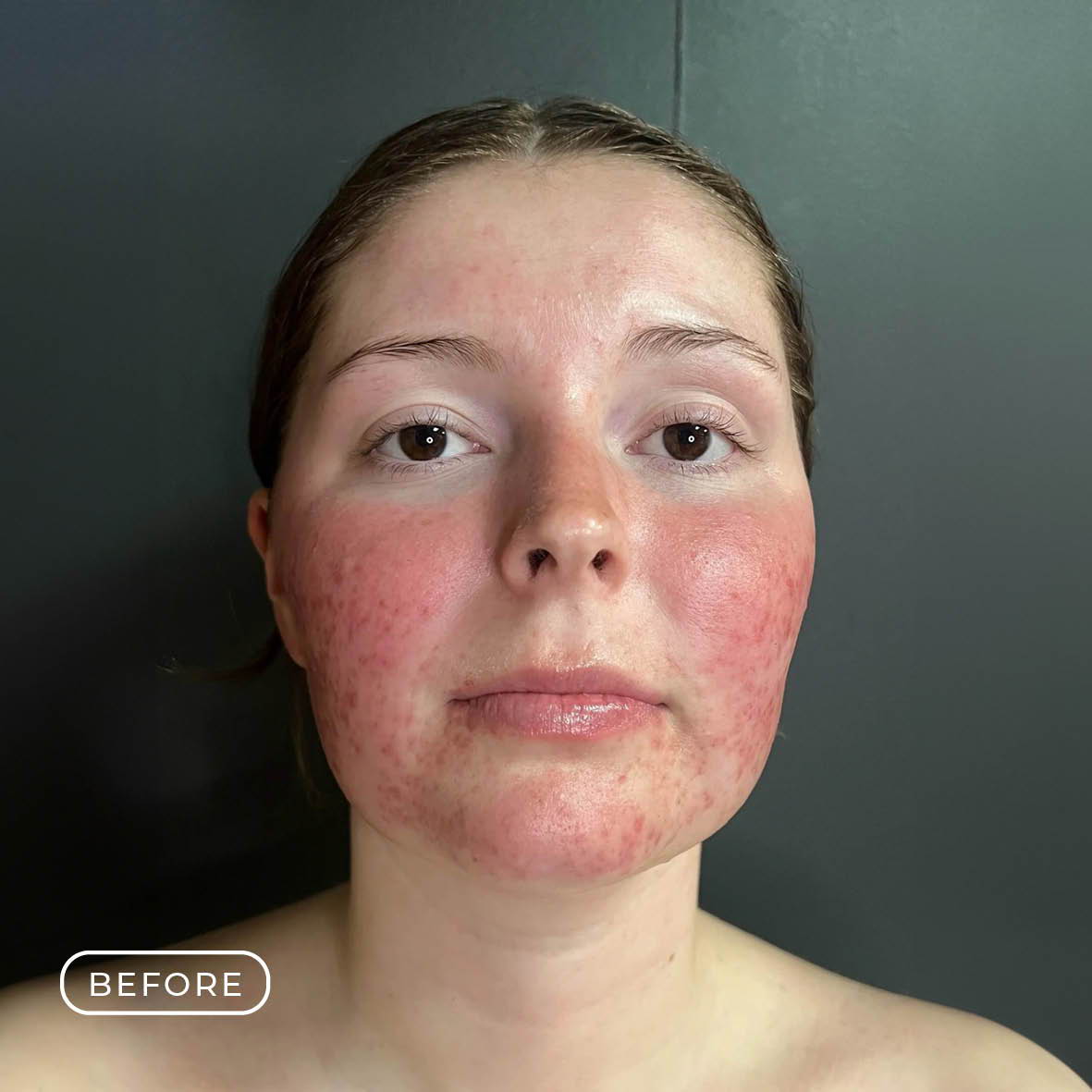 Rosacea