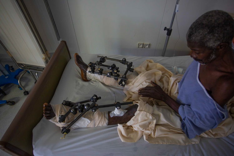 A victim from August 14 earthquake is being treated in Tabarre hospital after a referral from the South area, the most affected zone on Haiti. Copyright: Steven Aristil / MSF