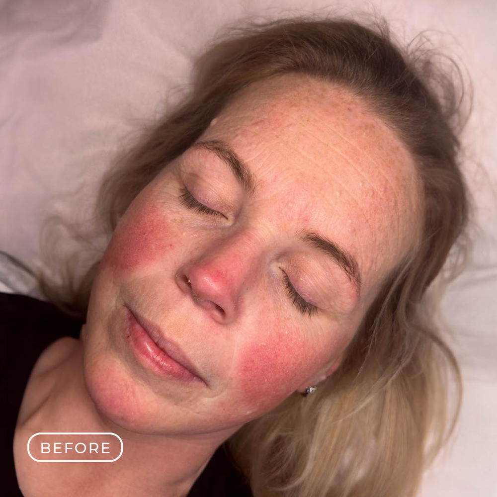 Before After Rosacea3