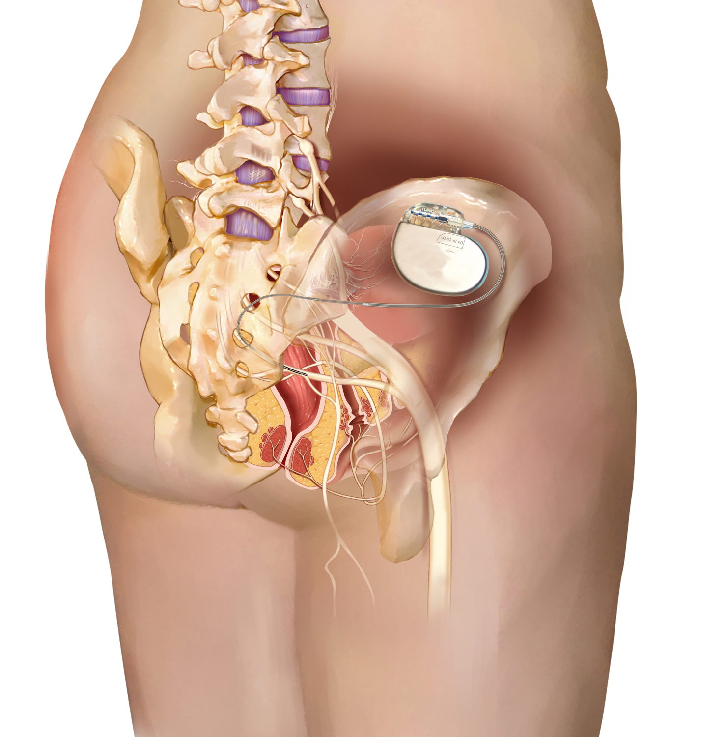 ©Medtronic