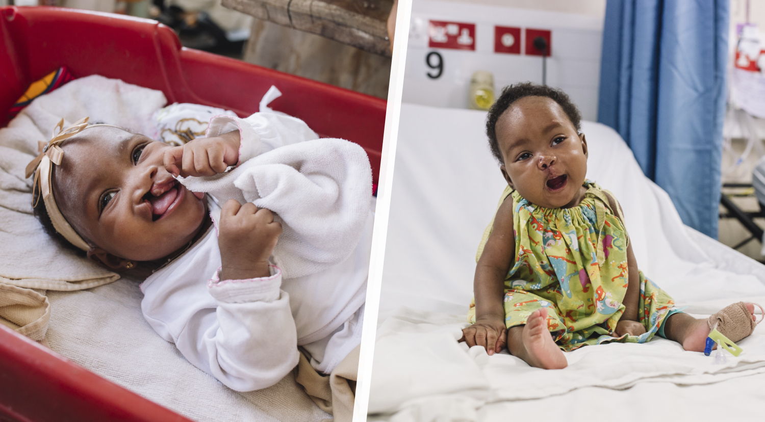 Before and after photos of Aissata's cleft lip surgery.