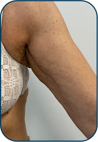 before arm 2