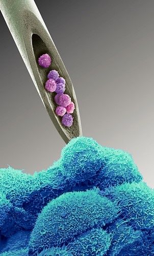Thérapie cellulaire, image conceptuelle. MEB colorisé d'une aiguille avec des cellules à l'intérieur et du tissu cancéreux (en bas). La thérapie des cellules souches et la thérapie des cellules T CAR sont deux exemples de thérapie cellulaire pouvant être utilisée pour traiter le cancer.