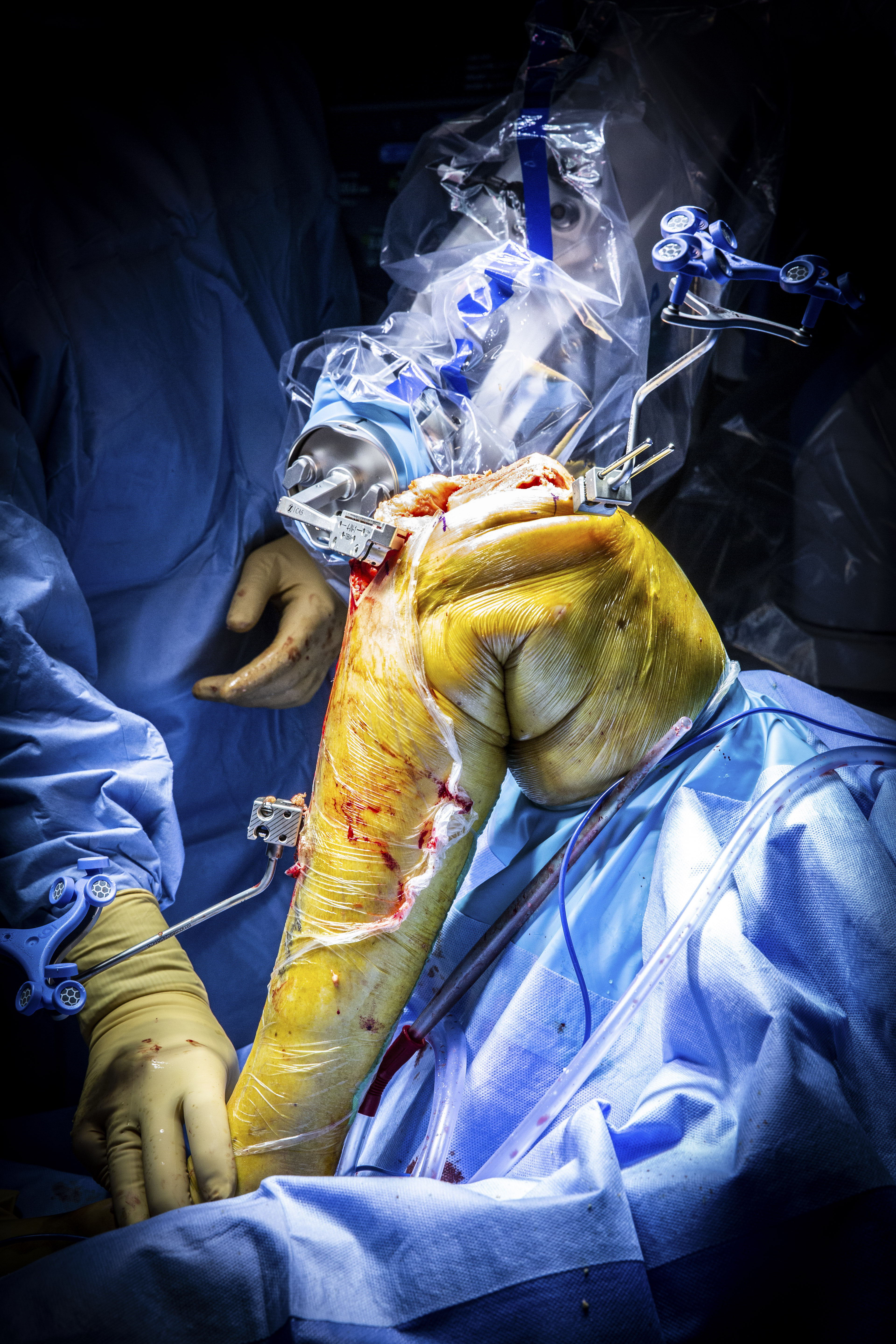 De uitvoering van het chirurgisch plan bij de plaatsing van de knieprothese met behulp van de ROSA-robot. (Foto: ZNA / Dirk Kestens)