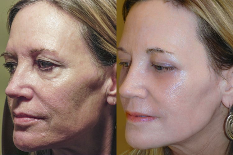 RESET for Sun Damage before and after 