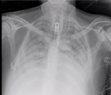 RX-foto longen met COVID-19 voor de transplantatie ©UZ Leuven