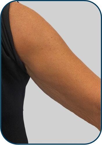 after arm 2