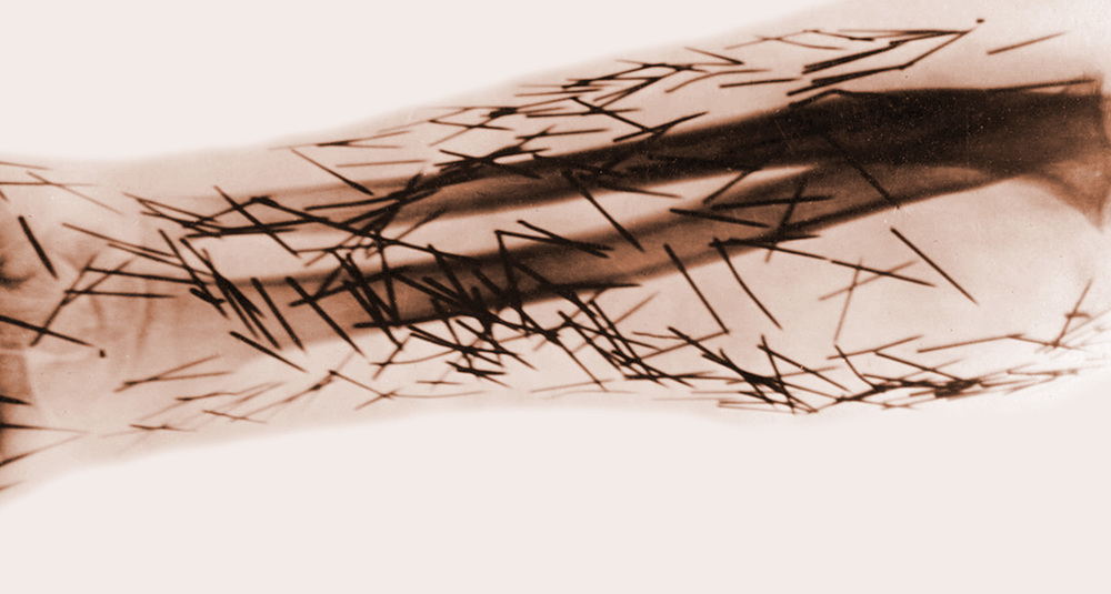 X-ray showing the result of self-mutilation with graphophone needles. Date unknown, possibly first or second decade of 1900s. AKG8442789 ©  akg-images / © NMHM / SCIENCE SOURCE
