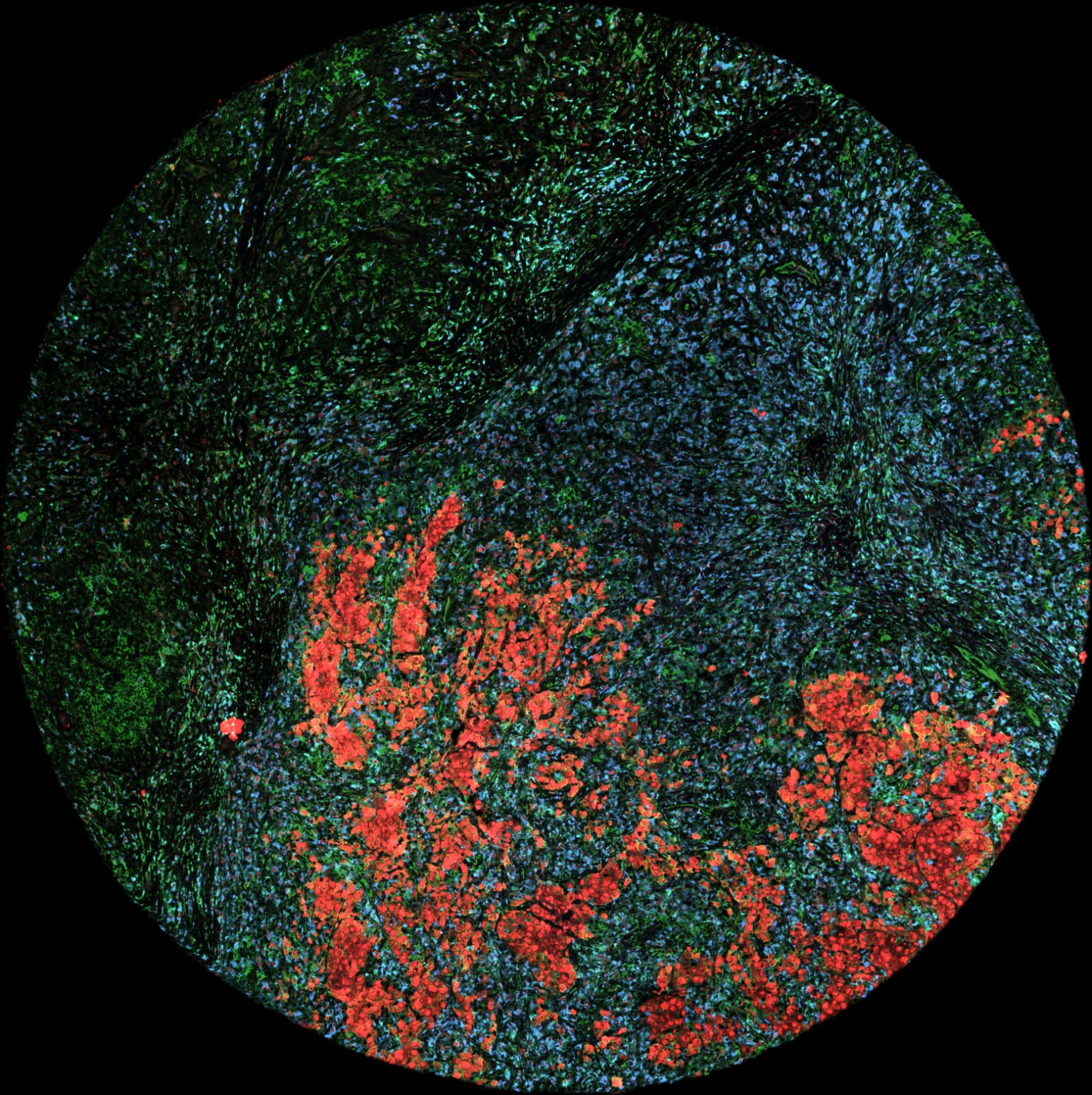Microscopiebeeld van menselijke melanoomcellen