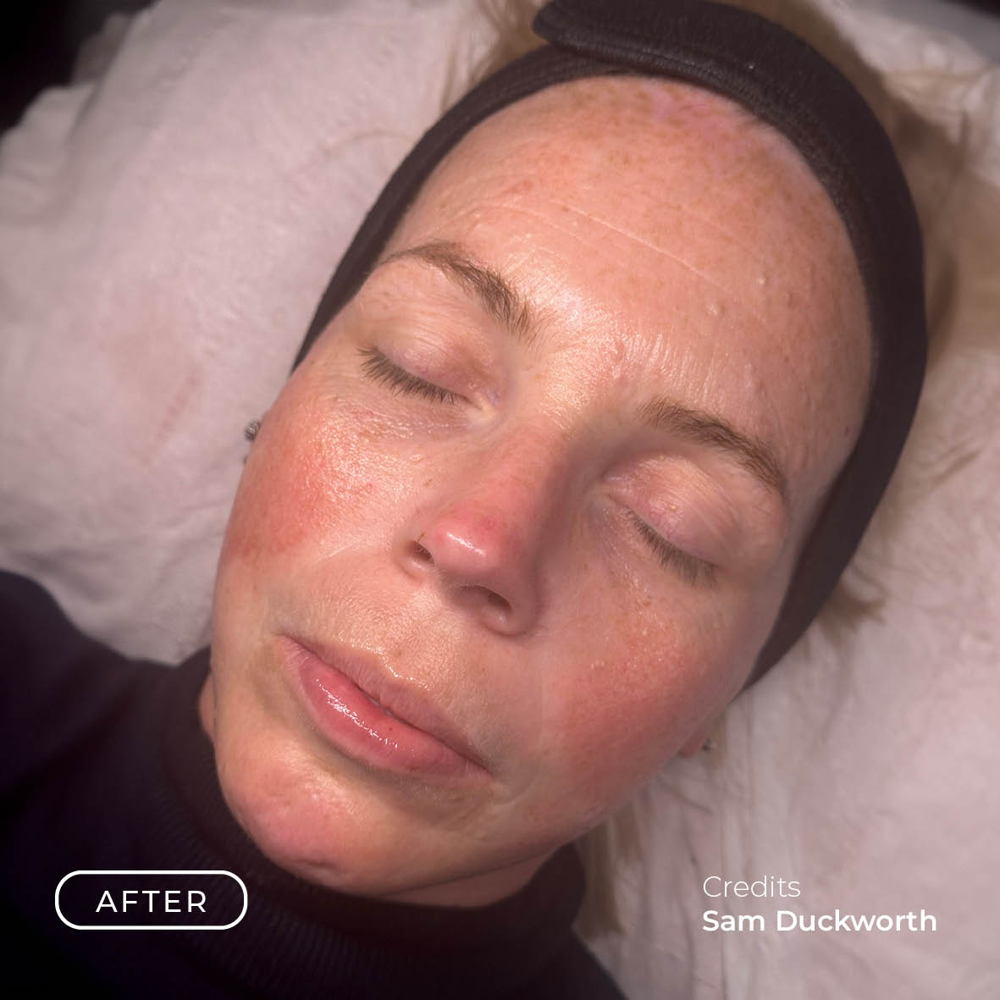 Before After Rosacea4