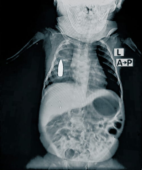 XRay of Baby Riyad. The 18-month-old toddler was struck in the chest by a stray bullet while he was taking a nap in Khartoum. Copyright: MSF
