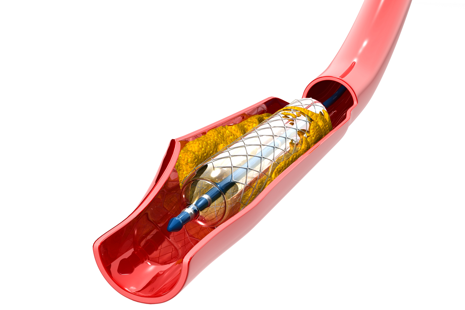 Een stent in een bloedvat/ Copyright Shutterstock