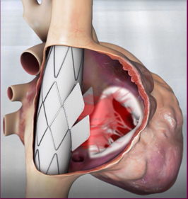 Stent-prothese geplaatst van bovenste tot onderste holle ader.