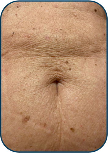 before abdomdem