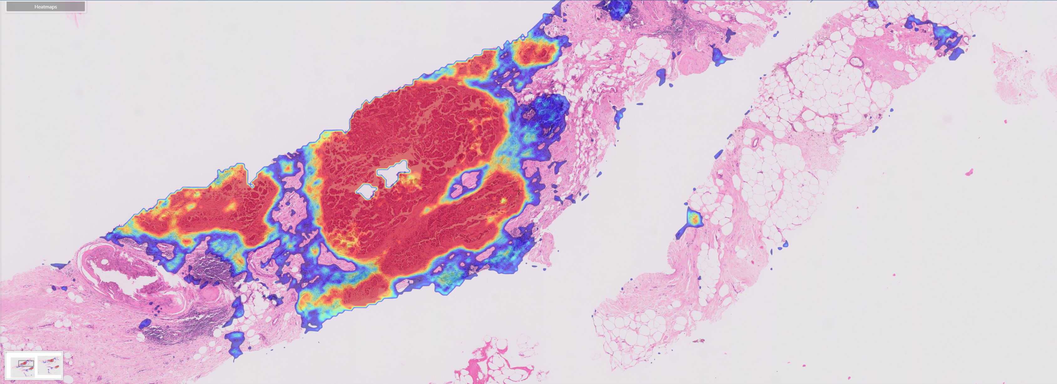 Scan van een borsttumor na analyse met artificiële intelligentie. De AI-software van Ibex Medical gidst de patholoog naar de interessante gebieden in een biopsie. Met de heat map duidt de AI de waarschijnlijkheid van een invasieve tumor (= kanker) aan, waarbij rood meer waarschijnlijk is. Zonder de AI moet de patholoog dit inschatten met het oog.