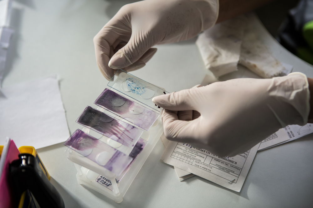 Preparing a slide for a differential leukocytes count. Photographer: Oksana Parafeniuk | Location: Ukraine | Date: 25/10/2018 Preparing a slide for a differential leukocytes count. Photographer: Oksana Parafeniuk | Location: Ukraine | Date: 25/10/2018