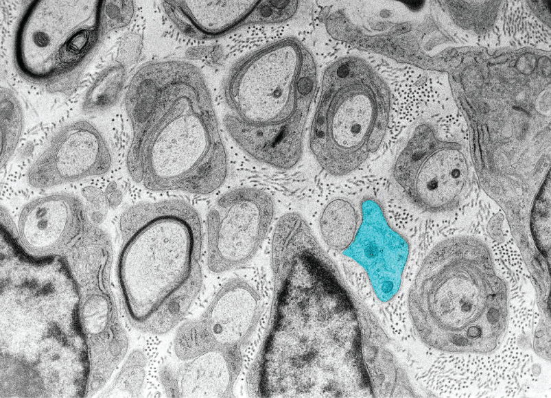 CMT1A immature Schwann cells have delayed initiation of myelination at postnatal day 6 in mice. A single immature Schwann cell is pseudocolored in blue. Prior et al, 2022. Credit: Robert Prior.