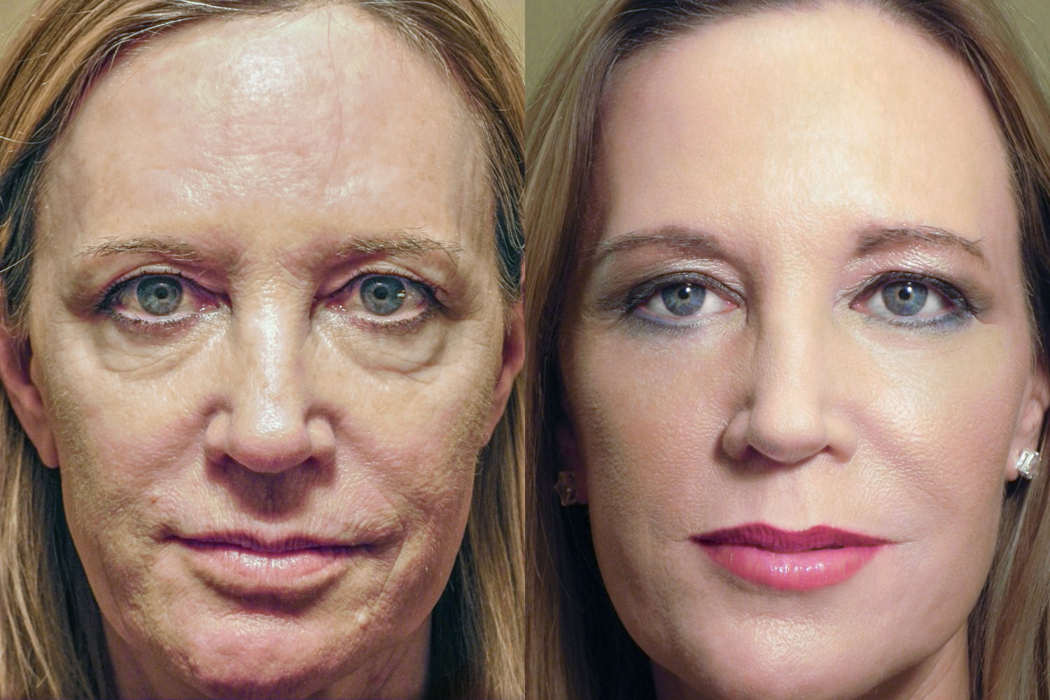 RESET patient before and after surgery with make-up. 