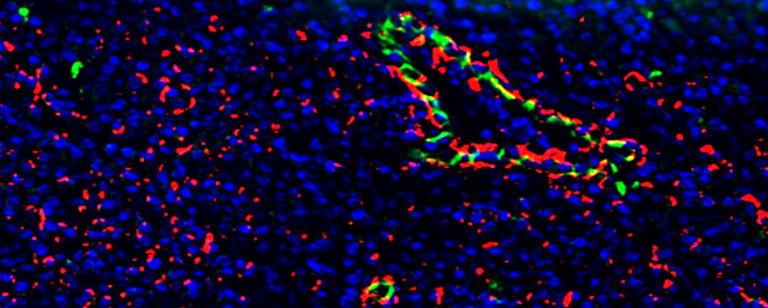 Disabling autophagy can enhance immune response in melanoma 