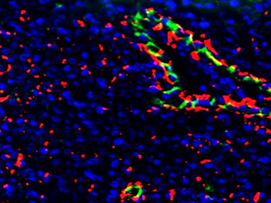 Disabling autophagy can enhance immune response in melanoma 