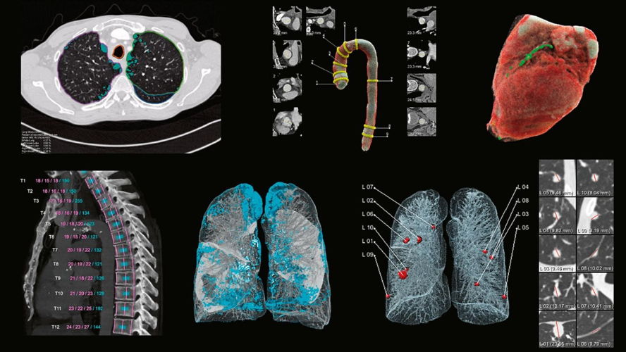 Un exemple des résultats que le radiologue reçoit de AI-Rad Companion qui inclus un pictogramme coloré, des reconstructions 3D des poumons, du cœur, de l’aorte et de la colonne vertébrale ainsi que les images originales avec la mise en évidence des anomalies détectées. 
