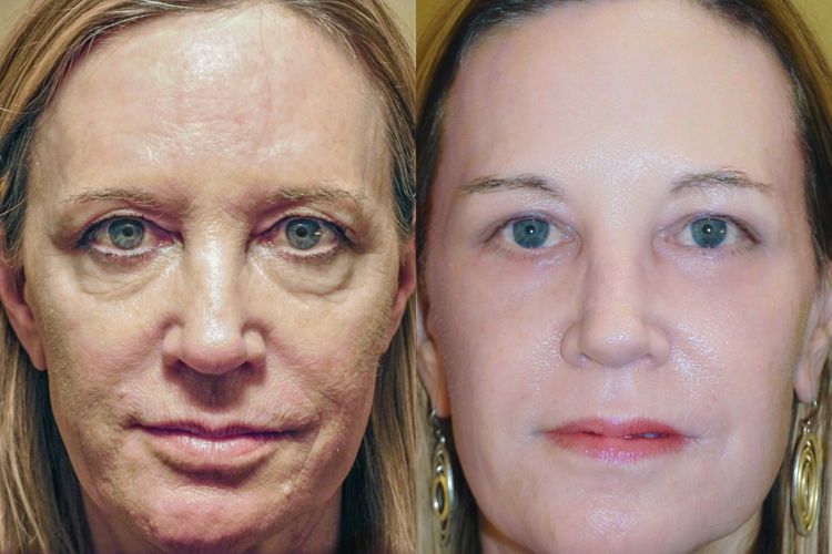 RESET patient before and after surgery; no make-up. 