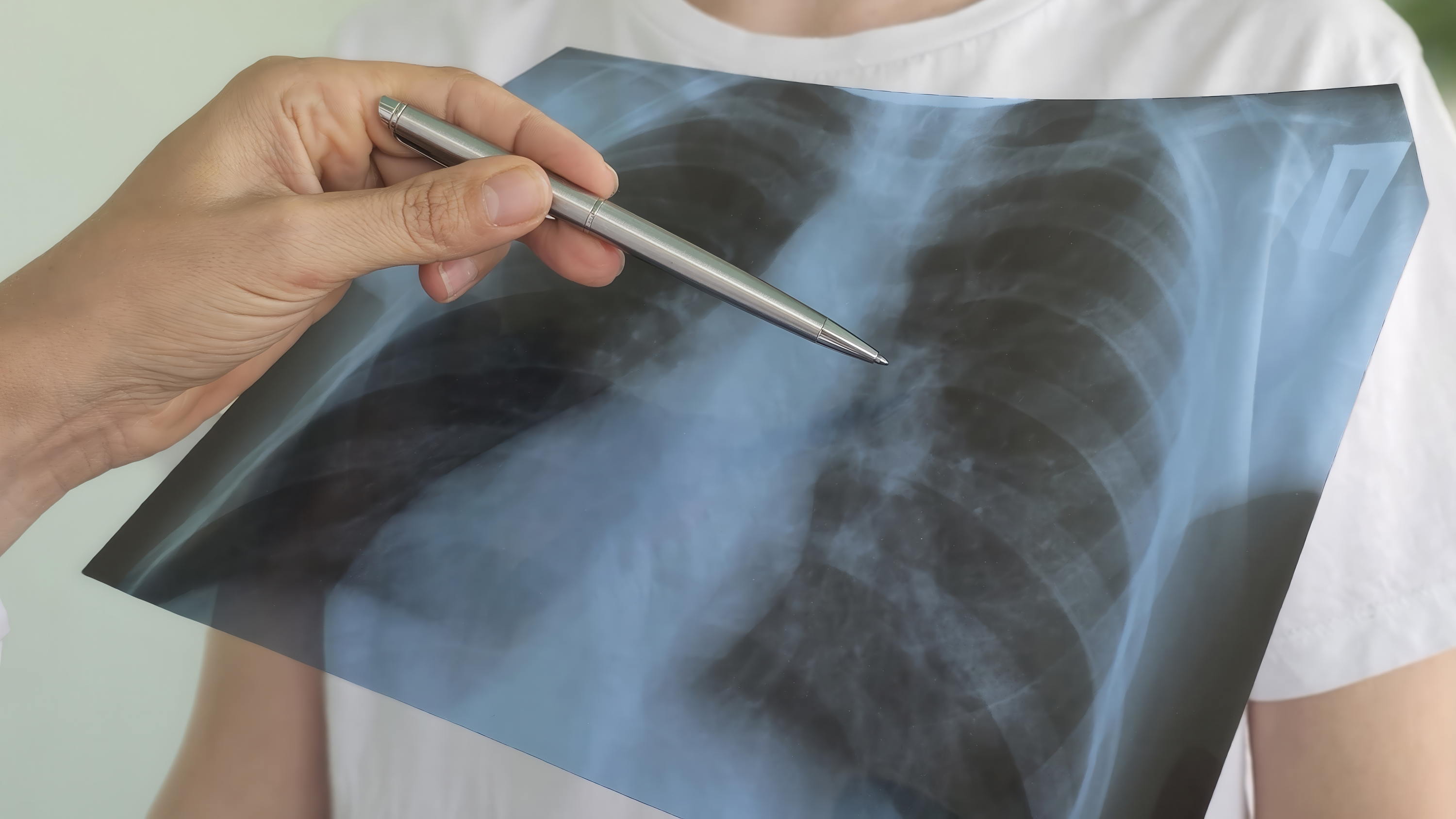 Nieuw longkankermodel toont hoe de locatie van een tumor de immuunreactie bepaalt